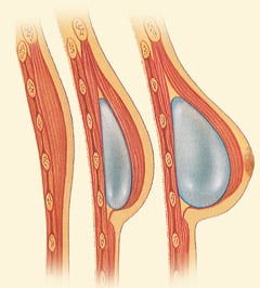 illustrated cross section side view of breast with tissue expander inside