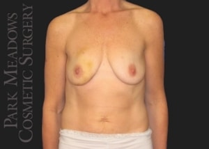 Autologous Reconstruction Using My Own Tissue For Reconstruction