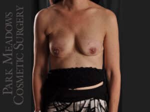 Bilateral DIEP Flap; two separate fat grafting sessions; nipple reconstruction and areola pigmentation