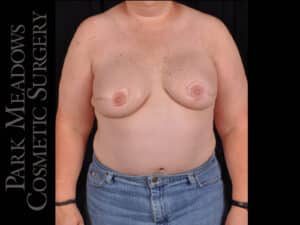 Bilateral DIEP Flap; three separate fat grafting sessions; nipple reconstruction and areola pigmentation