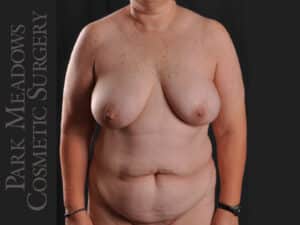 Bilateral DIEP Flap; three separate fat grafting sessions; nipple reconstruction and areola pigmentation