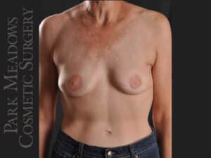 Bilateral DIEP Flap; one separate fat grafting session; nipple reconstruction and areola pigmentation
