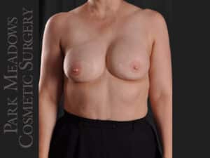 Bilateral mastectomy with tissue expanders; DIEP Flap; one separate fat grafting session; nipple reconstruction and areola pigmentation
