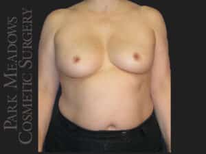 Bilateral mastectomy with tissue expanders; DIEP Flap; one separate fat grafting session; nipple reconstruction and areola pigmentation