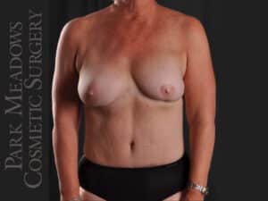 Bilateral DIEP Flap; two separate fat grafting sessions; nipple reconstruction and areola pigmentation