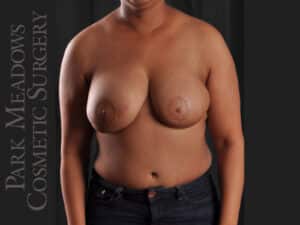 Bilateral mastectomy with tissue expanders; DIEP Flap; two separate fat grafting sessions; nipple reconstruction and areola pigmentation