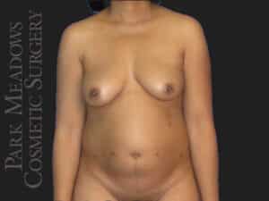 Bilateral DIEP Flap; four separate fat grafting sessions; nipple reconstruction and areola pigmentation