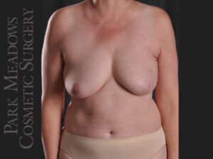 Bilateral DIEP Flap; two separate fat grafting sessions; nipple reconstruction and areola pigmentation