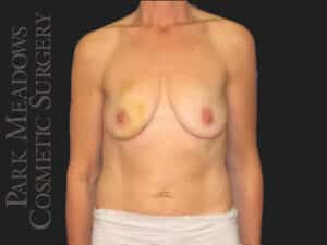 Bilateral DIEP Flap; three separate fat grafting sessions; nipple reconstruction and areola pigmentation