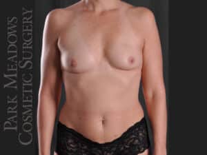 Bilateral nipple-sparing mastectomies with DIEP Flap; two separate fat grafting sessions