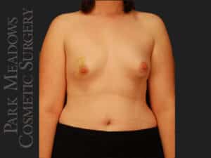 Bilateral mastectomy with tissue expanders; silicone implant exchange; two separate fat grafting sessions; nipple reconstruction; areola pigmentation