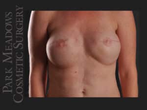 Bilateral mastectomy with tissue expanders; silicone implant exchange; three separate fat grafting sessions; nipple reconstruction; areola pigmentation
