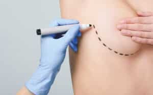 Breast shaping surgery